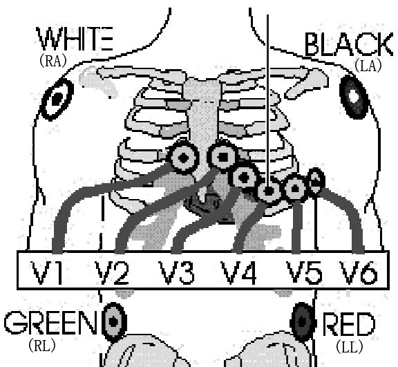 AAMI AHA 12-lead chest and limb electrode placement positioning diagram