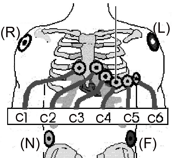 IEC standard 12-lead chest and limb electrode target placement map on patient body